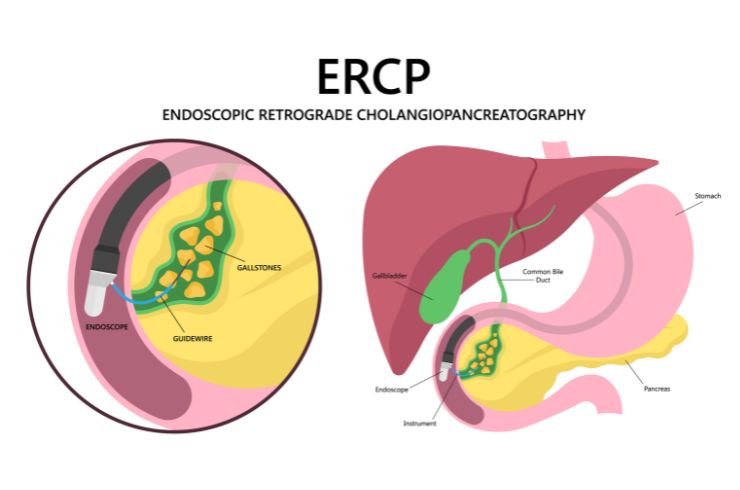 ERCP