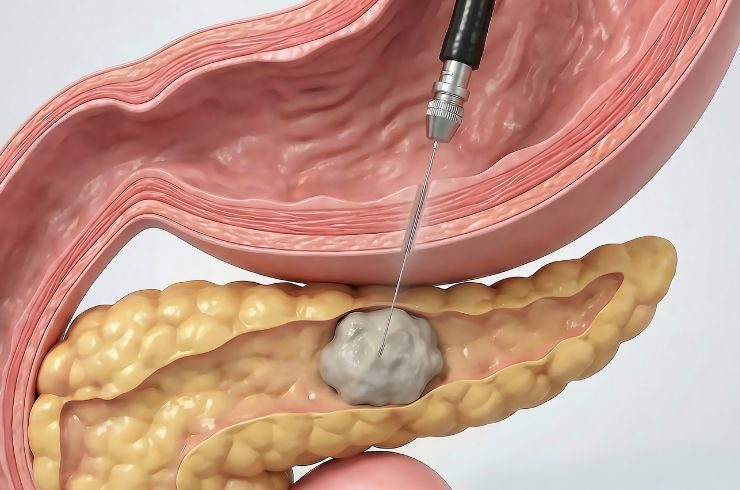 Endoscopic biopsy