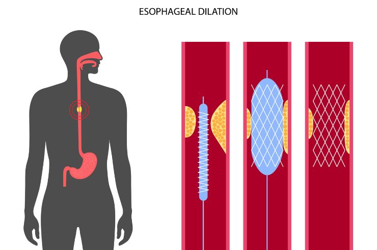 Gastrointestinal Stenting