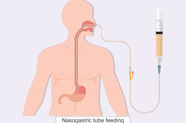 NG Tube