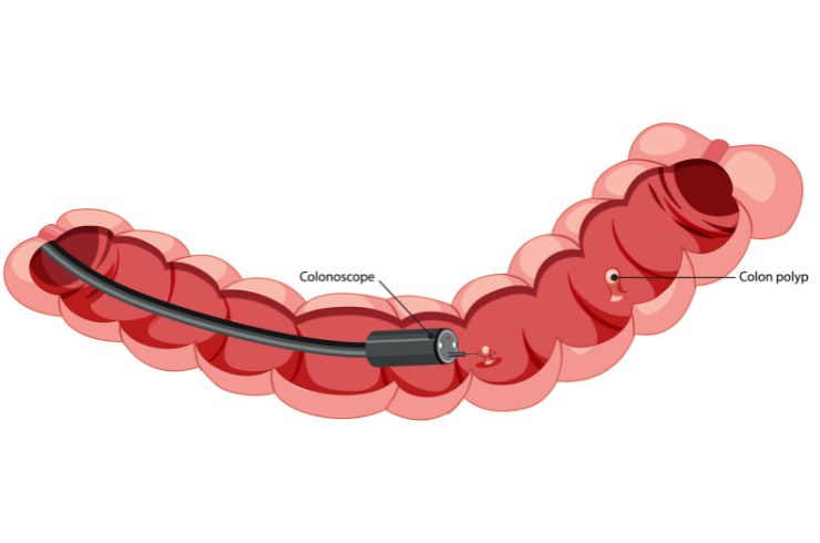 colonoscopy