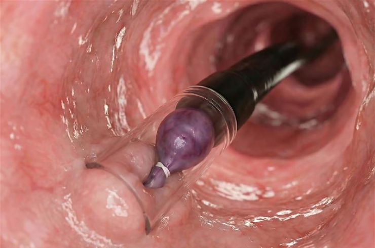 endoscopic variceal ligation