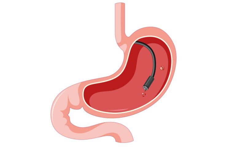 gastroscopy