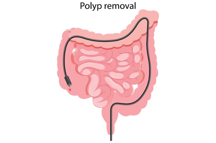 polypectomy