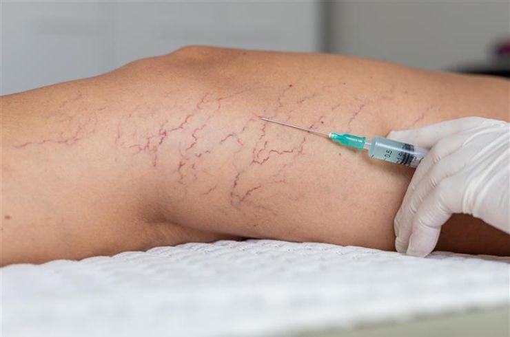 sclerotherapy